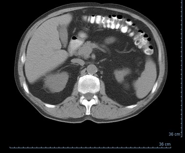 caso_fascitis_necrotizante/TAC_abdominal_hidronefrosis