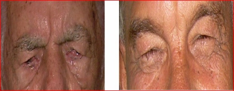 cirugia_plastica_belleza/indicacion_medica_blefaroplastia cirugia_plastica_belleza/indicacion_medica_blefaroplastia