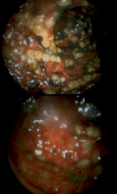 colitis_pseudomembranosa_inmunosupresion/lesiones_mucosa_endoscopia