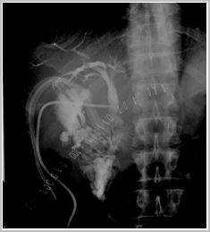 diagnostico_hidatidosis_abdominal/colangiografia_quiste_intervenido