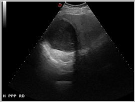 diagnostico_hidatidosis_abdominal/quiste_calcificado