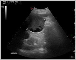 diagnostico_hidatidosis_abdominal/quiste_vesiculas_hijas