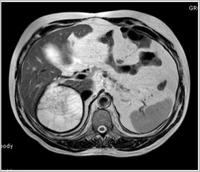 diagnostico_hidatidosis_abdominal/rm_fistulizacion_biliar