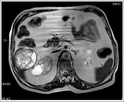 diagnostico_hidatidosis_abdominal/rm_quiste_hidatidico