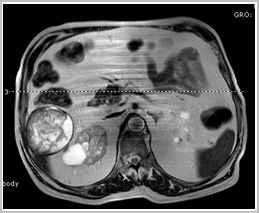 diagnostico_hidatidosis_abdominal/rm_quiste_peritoneal