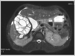 diagnostico_hidatidosis_abdominal/rm_ruptura_endoquiste