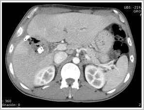 diagnostico_hidatidosis_abdominal/tc_abscesificacion_periquistectomia