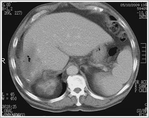 diagnostico_hidatidosis_abdominal/tc_quiste_abscesificado