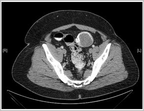 diagnostico_hidatidosis_abdominal/tc_quiste_pelvico