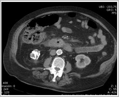 diagnostico_hidatidosis_abdominal/tc_quiste_renal