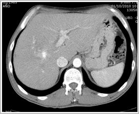 diagnostico_hidatidosis_abdominal/tc_sangrado_postintervencion