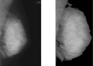 diagnostico_lesiones_mamografia/mamografias_tejido_fibroglandular diagnostico_lesiones_mamografia/mamografias_tejido_fibroglandular