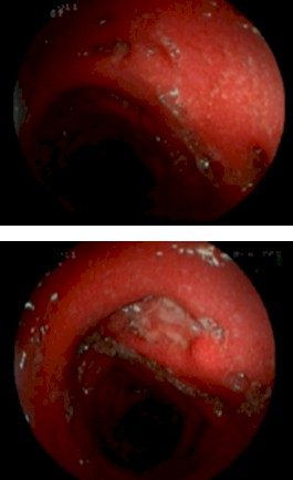 dolor_abdominal_diarrea/ulceras_boton_camisa