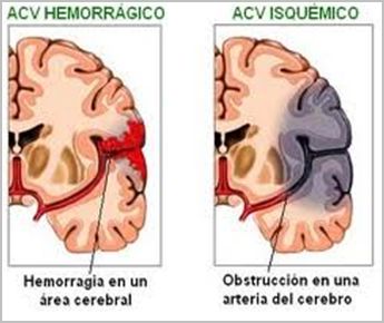 enfermedad_cerebrovascular/acv_mecanismos