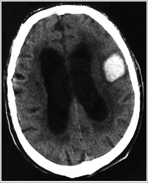 enfermedad_cerebrovascular/tc_hemorragia_intraparenquimatosa