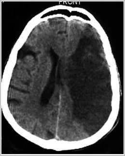 enfermedad_cerebrovascular/tc_infarto_hemisferico