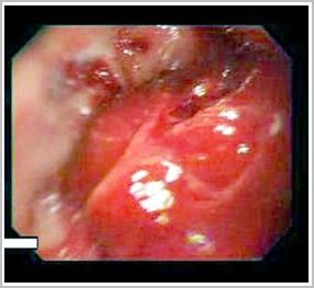 hemorragia_digestiva_esofago/esofago_lesion_pseudotumoral