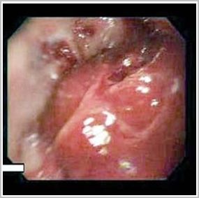 hemorragia_digestiva_esofago/lesion_tumoral_esofagica