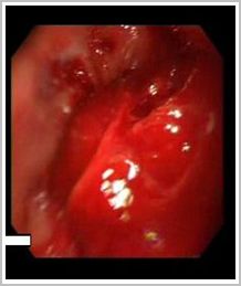 hemorragia_digestiva_esofago/lesiones_rojas_tumoral