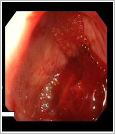 hemorragia_digestiva_esofago/sangrado_digestivo_chorro