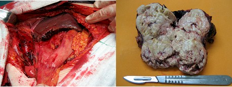 hepatocarcinoma_clinica_tratamiento/cirugia_cancer_higado hepatocarcinoma_clinica_tratamiento/cirugia_cancer_higado
