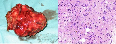 hepatocarcinoma_clinica_tratamiento/tumor_anatomia_patologica
