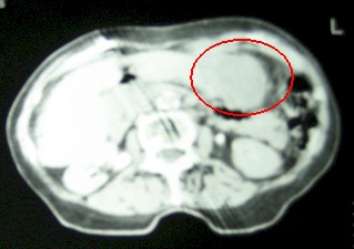 hepatocarcinoma_clinica_tratamiento/tumor_hepatico_TAC hepatocarcinoma_clinica_tratamiento/tumor_hepatico_TAC