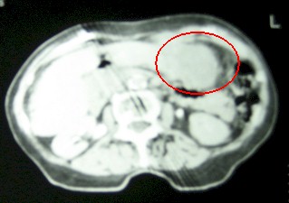 hepatocarcinoma_clinica_tratamiento/tumor_hepatico_TAC