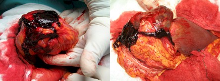 hepatocarcinoma_clinica_tratamiento/tumor_hepatico_cirugia hepatocarcinoma_clinica_tratamiento/tumor_hepatico_cirugia