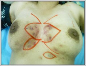 hidroadenitis_supurativa_recidivante/incision_marcaje_dermico hidroadenitis_supurativa_recidivante/incision_marcaje_dermico