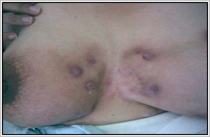 hidroadenitis_supurativa_recidivante/lesiones_maculopapulares_cicatrizales