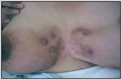 hidroadenitis_supurativa_recidivante/lesiones_maculopapulares_cicatrizales hidroadenitis_supurativa_recidivante/lesiones_maculopapulares_cicatrizales