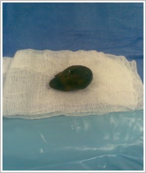 ilio_biliar_caso/macroscopia_calculo ilio_biliar_caso/macroscopia_calculo
