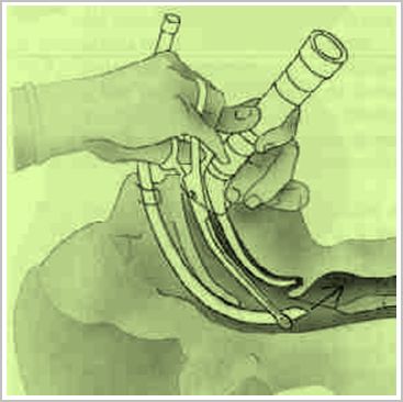 intubacion_endotraqueal_cirugia/intubacion_tecnica intubacion_endotraqueal_cirugia/intubacion_tecnica