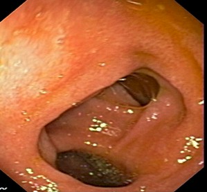 malnutricion_severa_ancianos/diverticulo_diverticulos_endoscopia