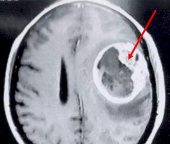 prevalencia_cefalea_jaqueca/RMN_tumor_cerebral