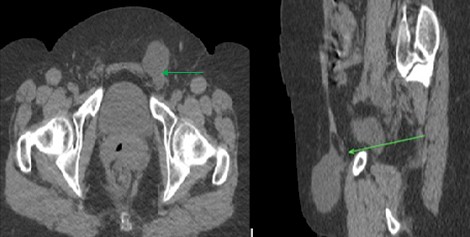 quiste_Nuck_hernia/TAC_conducto_diagnostico