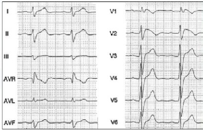 sindrome_Wolff-Parkinson-White/ECG_EKG_electrocardiograma