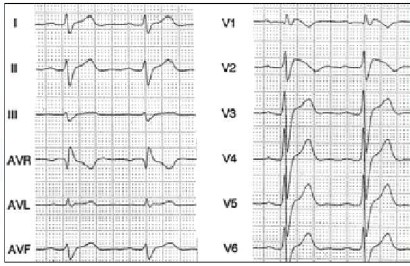 sindrome_Wolff-Parkinson-White/ECG_EKG_electrocardiograma sindrome_Wolff-Parkinson-White/ECG_EKG_electrocardiograma