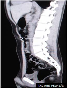 traumatismo_abdominal_penetrante/TAC_abdomino_pelvica1