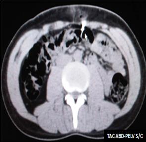 traumatismo_abdominal_penetrante/TAC_abdomino_pelvica2