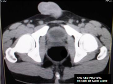 traumatismo_abdominal_penetrante/TAC_abdomino_pelvica3