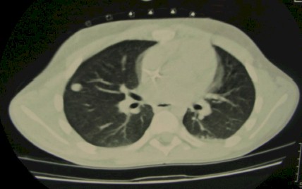TAC_toracoscopia_nodulo/pulmonar_solitario_localizacion
