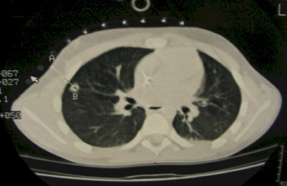 TAC_toracoscopia_nodulo/puncion_aguja_pulmonar