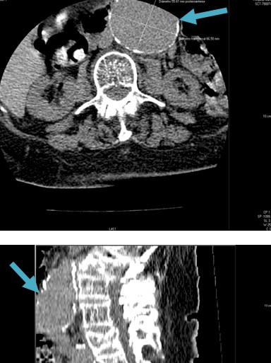 aneurisma_aorta_abdominal/TAC_abdominal_abdomen