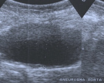aneurisma_aorta_abdominal/eco_ecografia_ultrasonografia