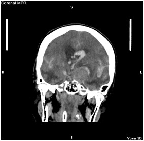 aneurisma_cerebral_roto/Aneurisma_ACAI_Hemorragia_Subaracnoidea