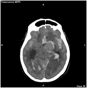 aneurisma_cerebral_roto/Aneurisma_ACAI_Hiperdensa