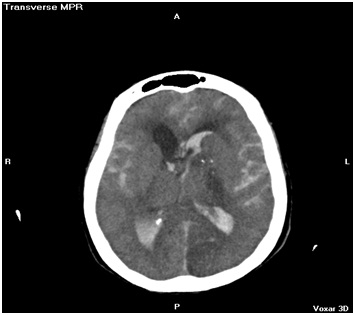 aneurisma_cerebral_roto/Hemorragia _Subaracnoidea _Intraventricular