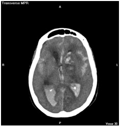 aneurisma_cerebral_roto/Hemorragia_intraventricular_infratentorial